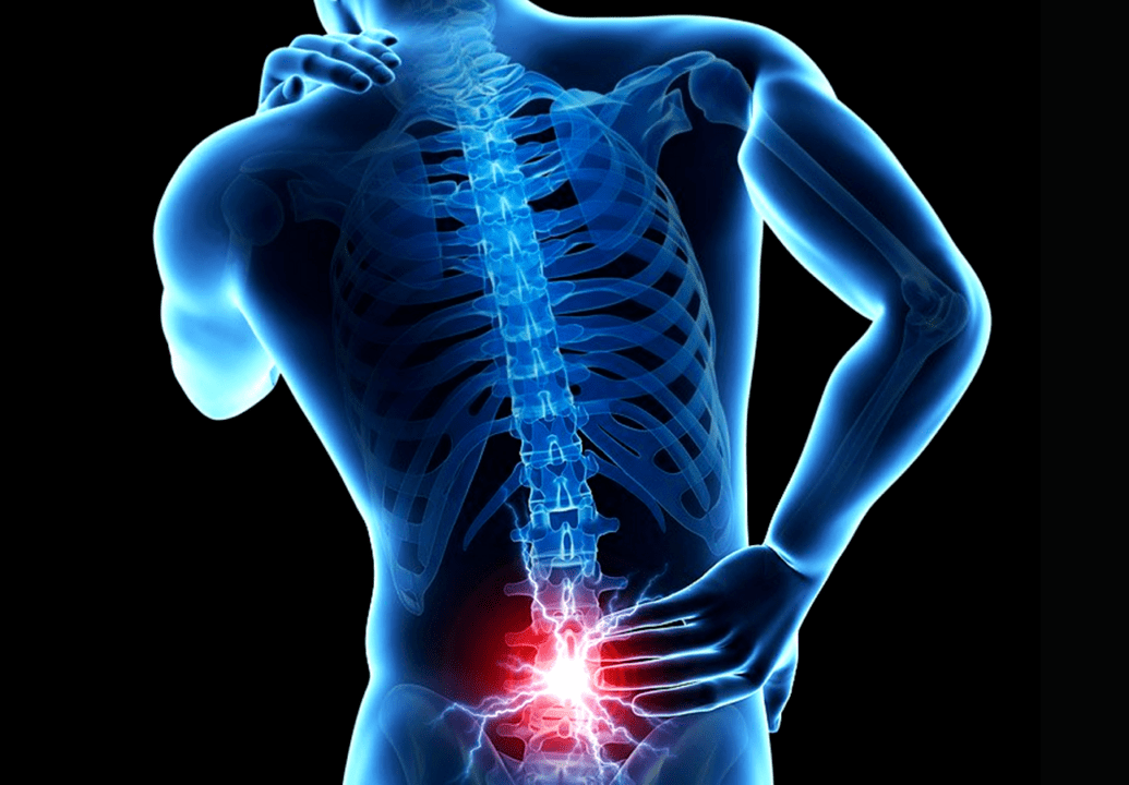 Signos de osteocondrose lumbar