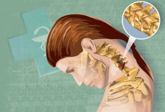 Síntomas reflexos dunha osteocondrose do pescozo