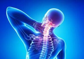 Osteocondrose