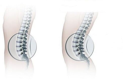 Columna vertebral normal e aumento da lordose lumbar