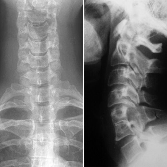 Radiografía da columna cervical
